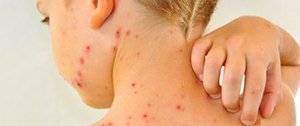 Soins dermatologiques: Varicelle