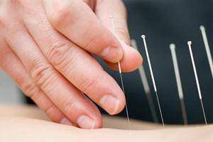 L'acupuncture chinoise