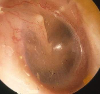 Quelles sont les principales maladies rencontrées au niveau de l’oreille externe ?