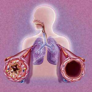 Asthme : Les mécanismes associés