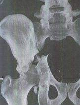 Chutes et fractures