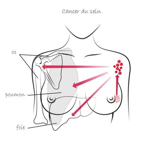 évolution et pronostic du cancer du sein