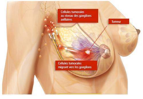 Cancers hormonaux féminins:Cancer du sein