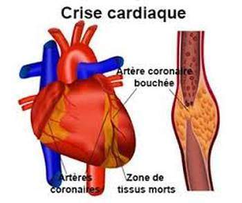 Infarctus: Prévenir l’infarctus du myocarde