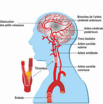 infarctus:Comment prévenir les accidents vasculaires cérébraux ?
