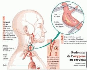 Infarctus, attaques cérébrales, c’est non !