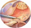 La chirurgie : les reins et les voies urinaire