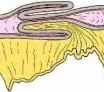 Anatomie pathologique de l'invagination intestinale aigue