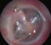 Atteintes de l'oreille moyenne:Rétraction de la membrane tympanique