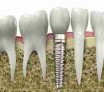 Un implant permet de remplacer n'importe quelle dent absente