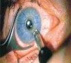 La chirurgie : les yeux, au microscope