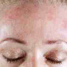 Peau : Psoriasis