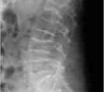 L'ostéoporose : Le diagnostic radiographique d'une fracture vertébrale