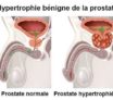Adenome-prostate