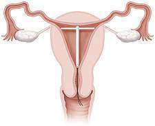 Contraception règles diu33